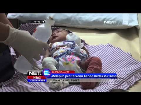 Bayi Asal Nganjuk Derita Penyakit Kulit Langka - NET12