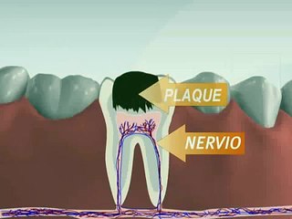 Dr Daniel Wank | 3d Medical Animation Root Canal