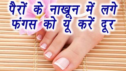 Toenail fungus: 5 ways to clean it | पैरों के नाखुन में लगे फंगस को यूं करें साफ | Boldsky