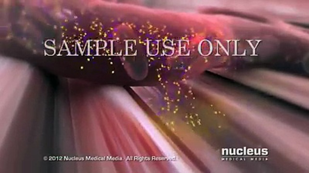 DIABETES MELLITUS TIPO 2