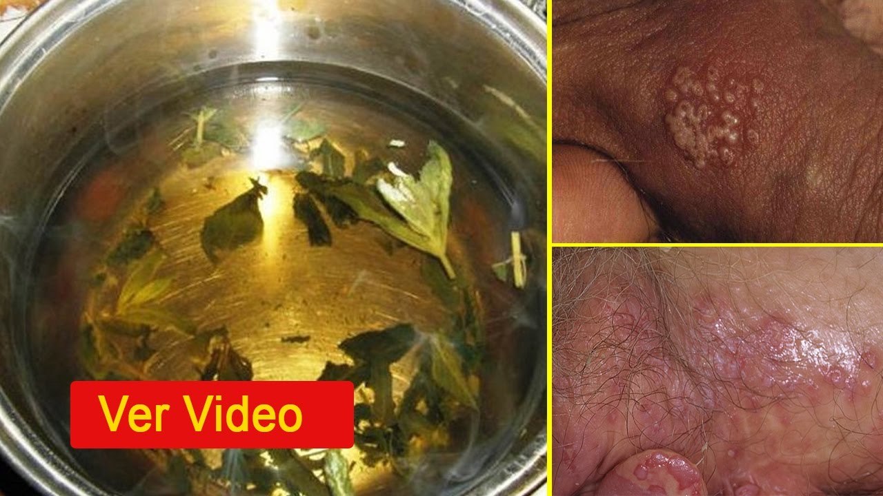 Herpes genital tratamiento 3 aditivos que previenen los brotes recurrentes (1)