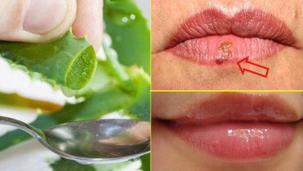 Erupción labial remedios naturales y  6 tratamientos sencillos para el herpes