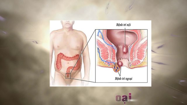 Phòng Khám Điều Trị Bệnh Trĩ Hiệu Quả Tại TPHCM - Phòng Khám Đa Khoa Thế Giới