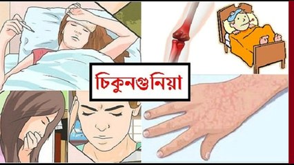 Chikungunya virus চিকুনগুনিয়া'র লক্ষণ ও প্রতিকার