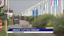 Five-Year-Old Boy Suffers Allergic Reaction to Henna Tattoo
