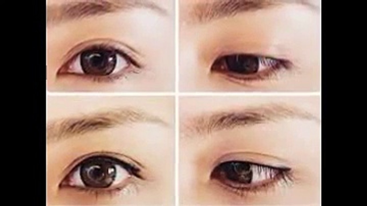 Nhấn mí Hàn Quốc không đau không để lại sẹo
