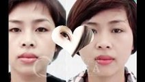 Nhấn mí Hàn Quốc giải pháp hoàn hảo để mang đến đôi mắt đẹp tự nhiên
