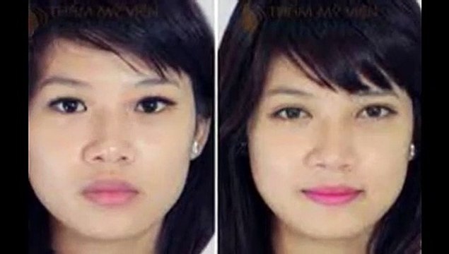 bấm mí hàn quốc là gì - Thẩm mỹ viện Hà Nội