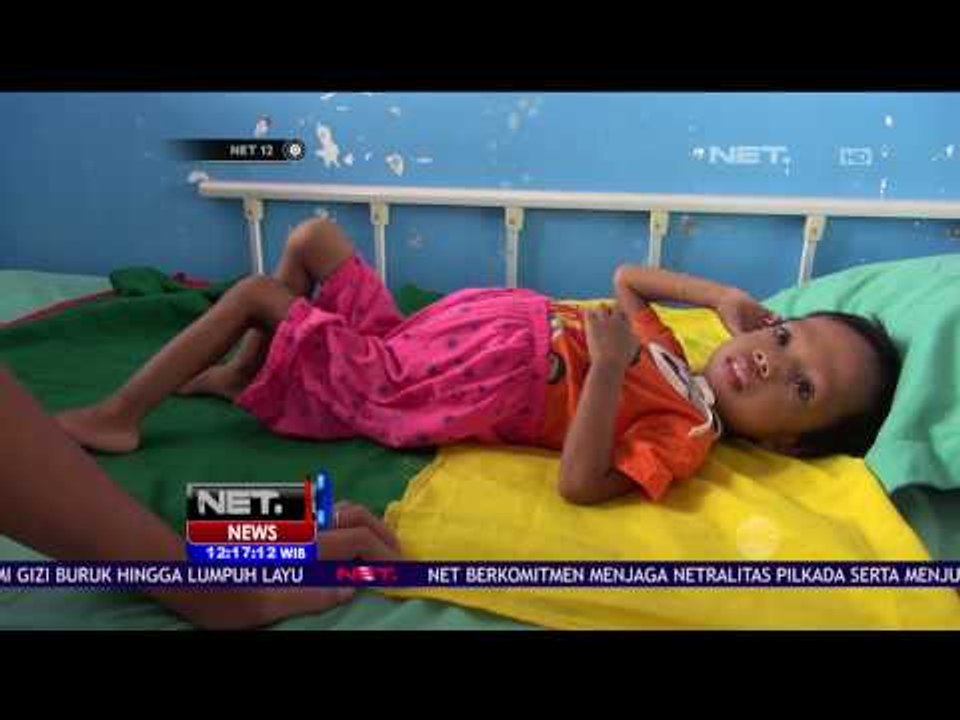 3 Anak Gizi Buruk Hingga Lumpuh Layu di Kabupaten Asahan Sumut - NET12