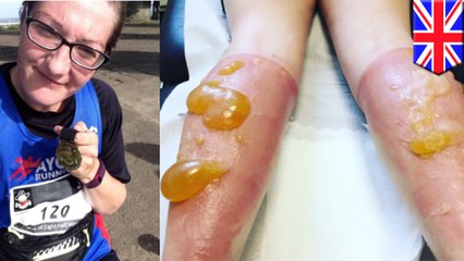 วิ่ง 110 กิโลเมตร โดนแดดนเผาจนสยอง