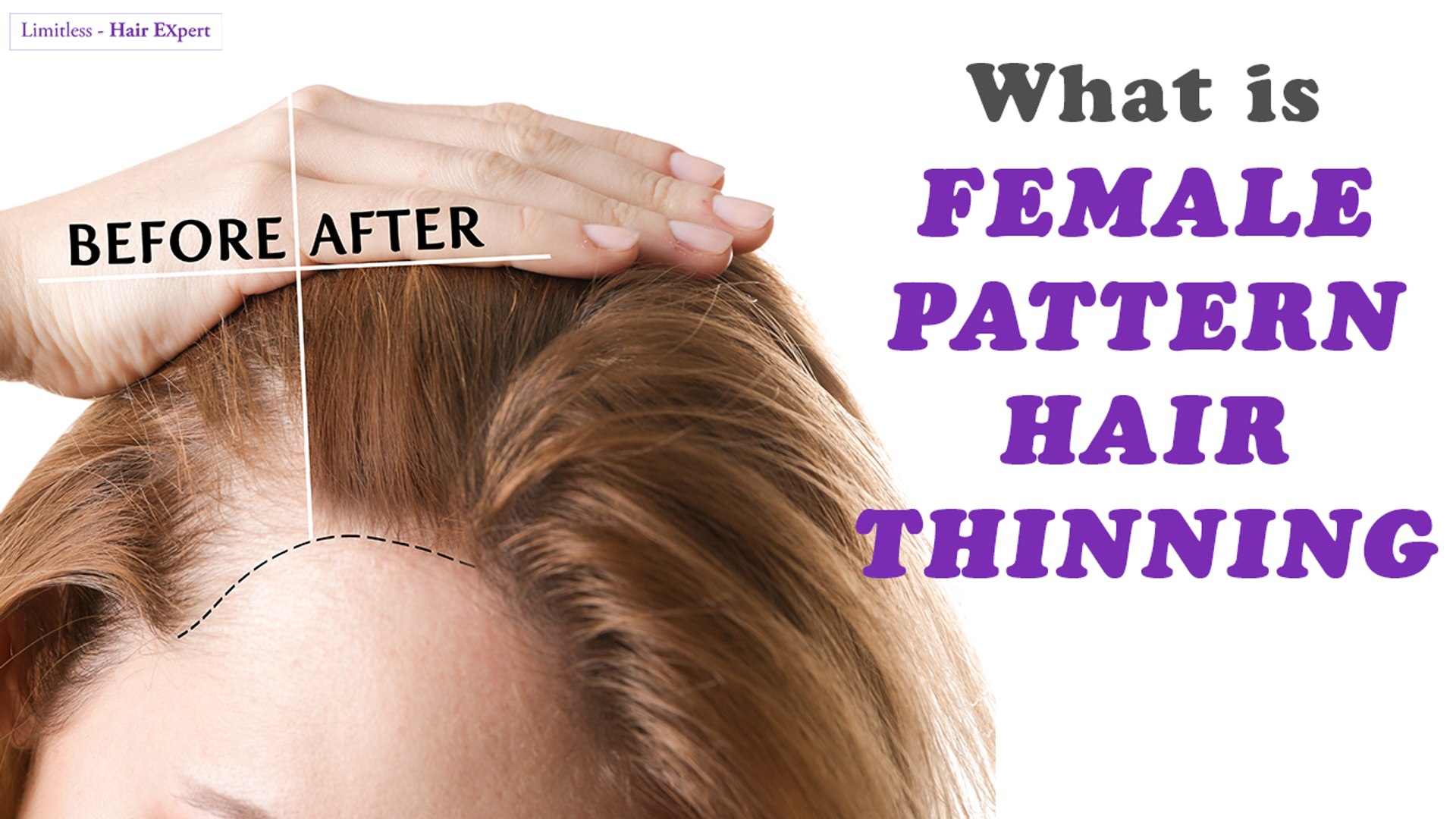 Everything Women Should Know About Female Pattern Hair Thinning