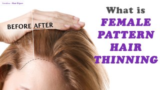 Everything Women should KNOW about Female Pattern Hair Thinning-Hair Expert Dino