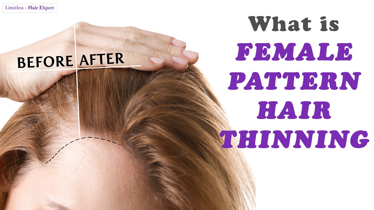 Everything Women should KNOW about Female Pattern Hair Thinning-Hair Expert Dino