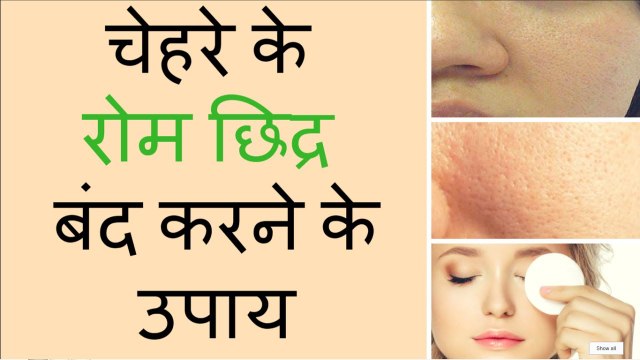 चेहरे के छिद्र कैसे दूर करे Home Remedies for Open Pores in Hindi