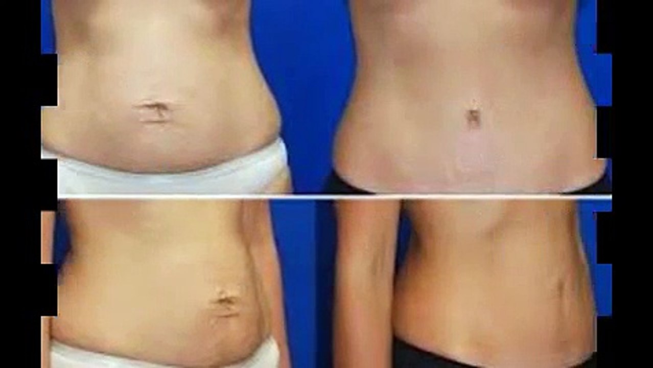 Mỡ bụng sẽ không còn sau khi thẩm mỹ căng da bụng