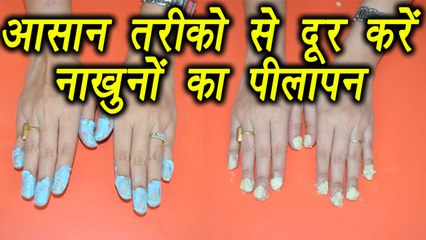 Nail whitening Remedy | How to get rid of yellow nails | पीले नाखुन से ऐसे पाऐं छुटकारा  | BoldSky