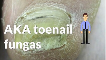 Zeta Clear - Fall in love with your Flipflops once more