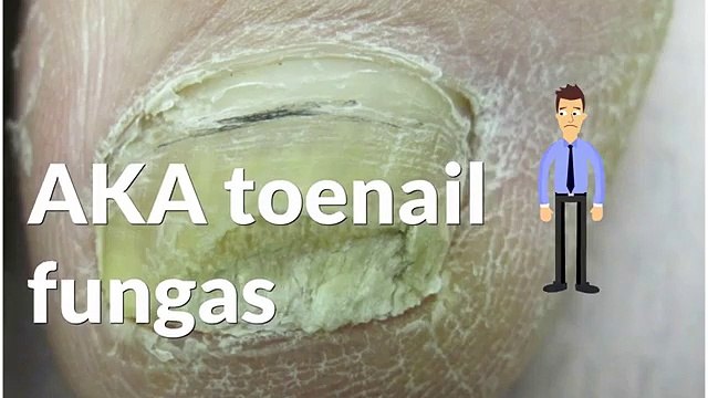 Zeta Clear - Fall in love with your Flipflops once more