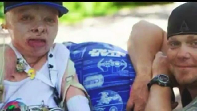 Man Who Suffered Severe Burns as Child Grows Up to Be Counselor at Burn Camp