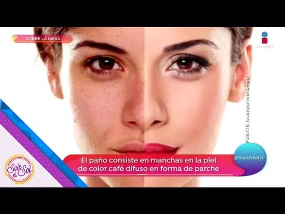 Paño de piel: ¿Por qué salen esas manchas en tu piel?