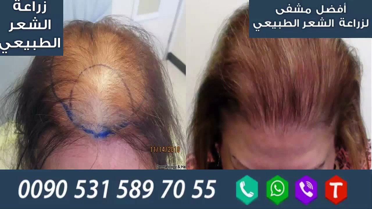 تكلفة زراعة الشعر في تركيا و زراعة الشعر في تركيا