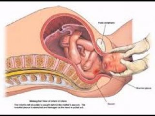 erb's palsy-causes-symptoms-appearance-affects