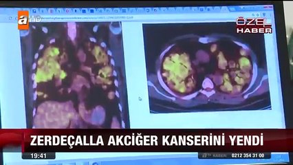 Zerdaçal İle Kanseri yendi Zerdaçal Mucizesi Tıp dünyasından geçti..._Bilge_
