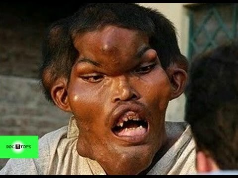 Las 15 Enfermedades Más Extrañas Del Mundo