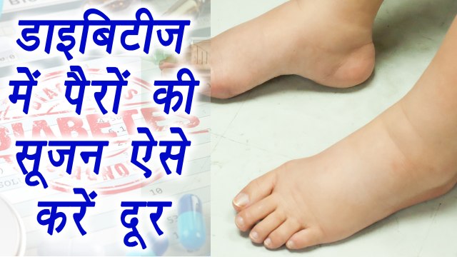 Diabetic Foot Pain | Home remedies | डाइबिटीज़ में पैरों की सूजन ऐसे करें दूर | Boldsky