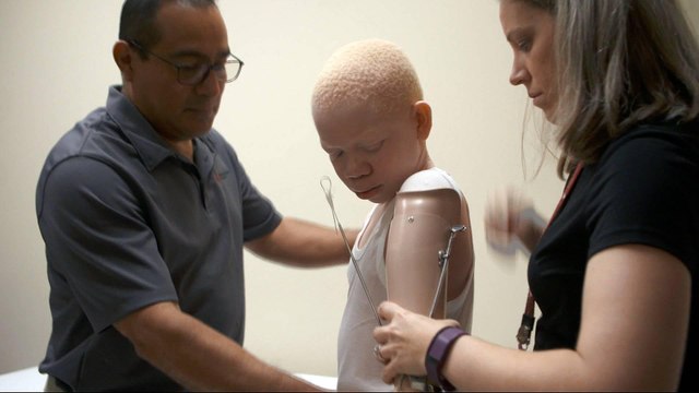 Tanzanian albino victims receive treatment in the US