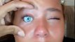Une fille Brésilienne regrette avoir mis un œil de poupée sur la cornée de son œil