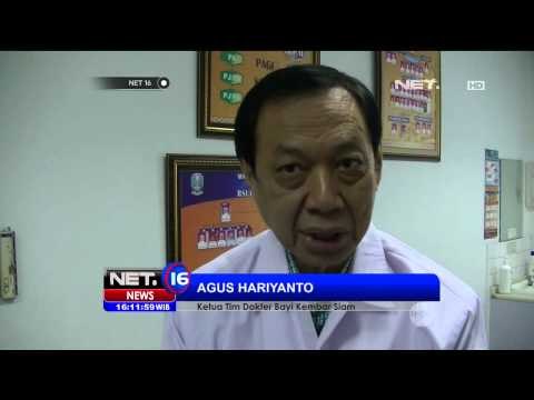 Dua Bilik Jantung Bocor, Bayi Kembar Siam Kritis Dirawat di RSUD dr Soetomo - NET16