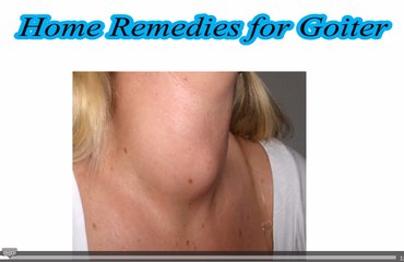 Home Remedies for Goiter
