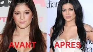 Kylie jenner chirurgie esthétique avant apres transformation