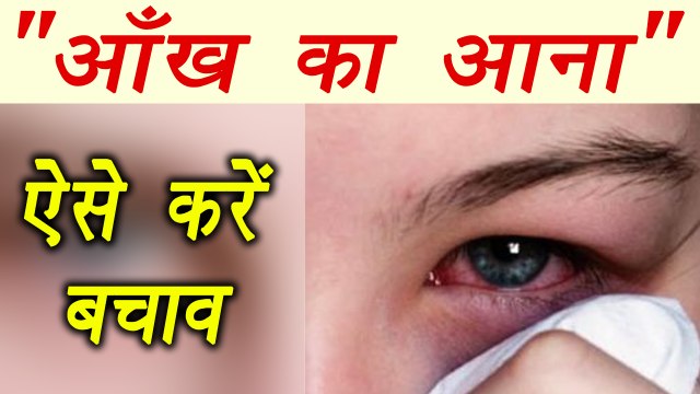 Prevent Conjunctivitis by these Home Remedies | आँख आने का ऐसे करें बचाव | Boldsky