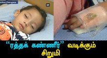 3-year-old terrifies parents, doctors by crying tears of blood-Oneindia Tamil