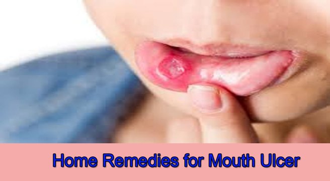 मुहं के छालों के घरेलू उपचार । Home remedies for Mouth Ulcers