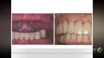 Effective Receding Gums Treatment