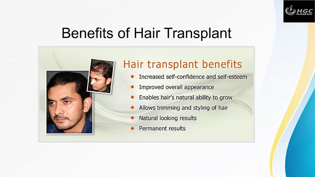 Benefits of Hair Transplant