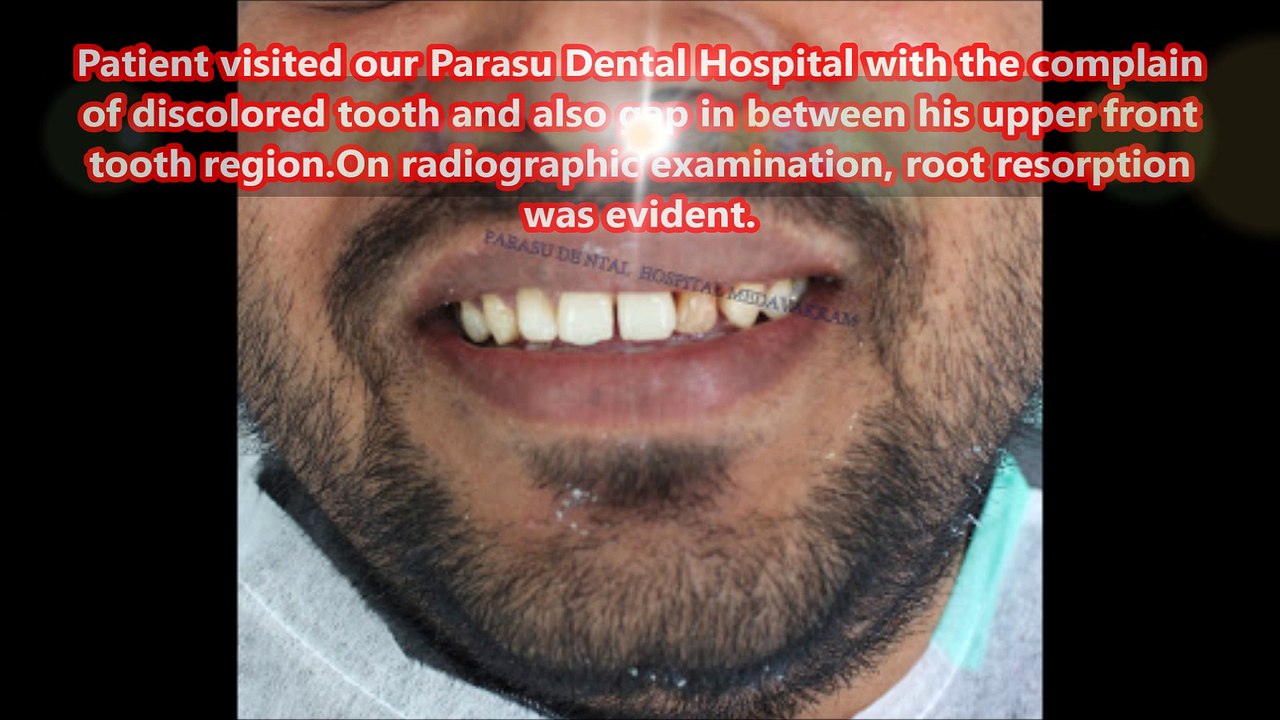 Dental implant center in chennai