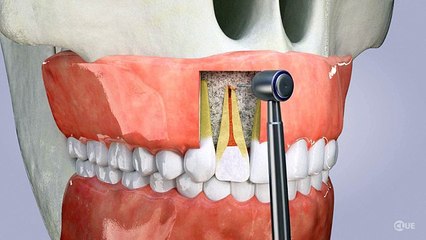 Apicoectomy  The Centre for Oral Surgery in Joliet  High Quality Oral Suregery in 60431