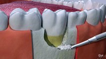 Bone Grafting  The Centre for Oral Surgery in Joliet  Teeth Replacement near Joliet IL