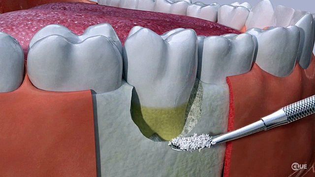 Bone Grafting The Centre for Oral Surgery in Joliet Teeth Replacement near Joliet IL