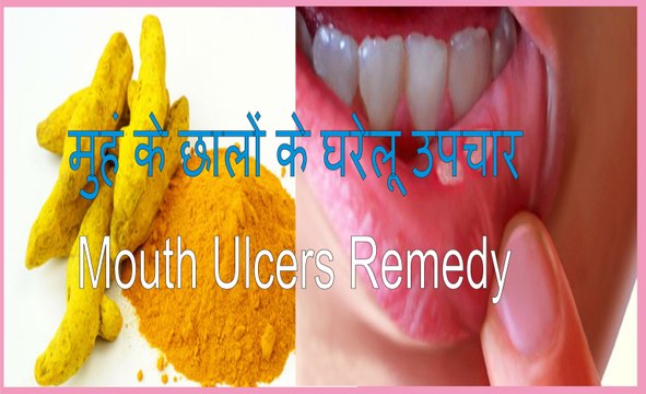 मुहं के छालों के घरेलू उपचार । Home remedies for Mouth Ulcers