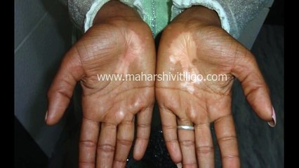 Melanocyte Transplantation at Maharshi Vitiligo Centre, Mumbai