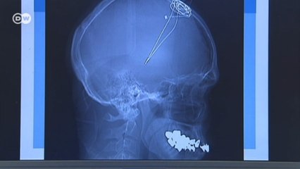 Marca-passo cerebral inibe sintomas do Parkinson