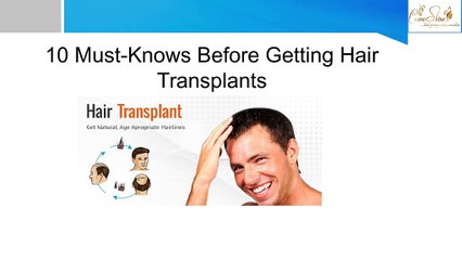 10 Must-Knows Before Getting Hair Transplants