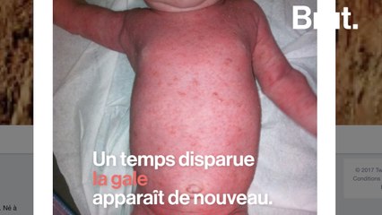 La gale est-elle de retour en France ?