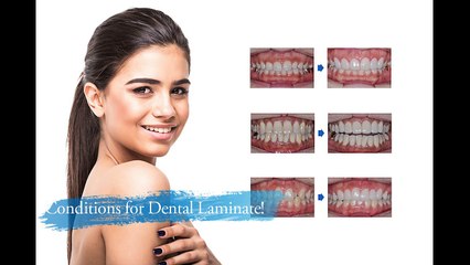Laminate | A Way to Change the Tooth Color & Shape – The Star Dental Clinic