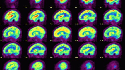 California Doctors Hope To ‘Rewire' Depressed People's Brains